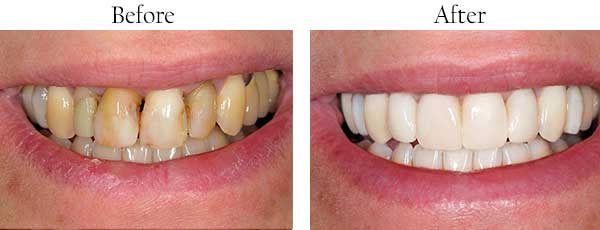 Rio Rancho Before and After Dental Implants