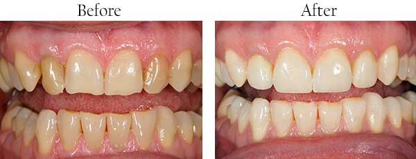 Corrales Before and After Teeth Whitening