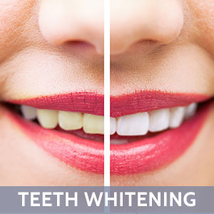 Corrales Teeth Whitening